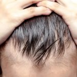 Hair Loss Treatment