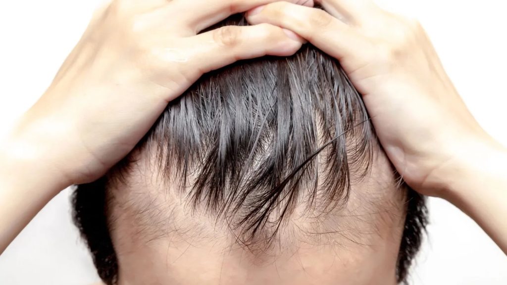 Hair Loss Treatment