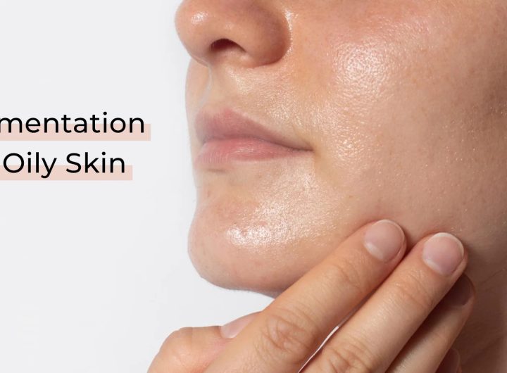 Most Common Types of Skin Pigmentation Issues in Women